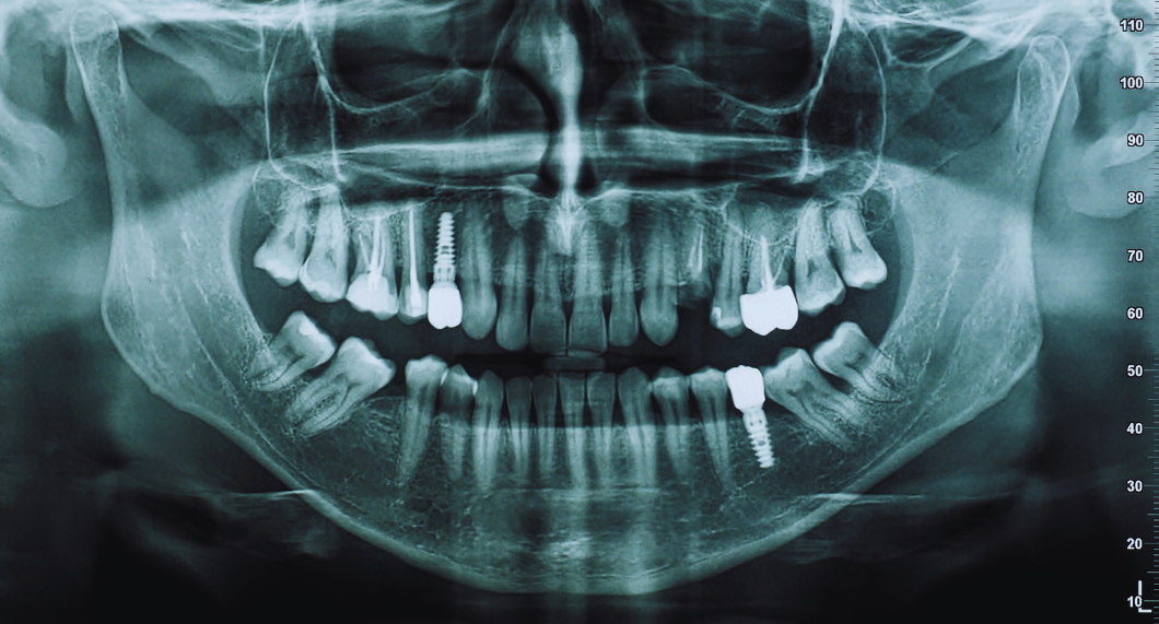 La radiographie en ODF